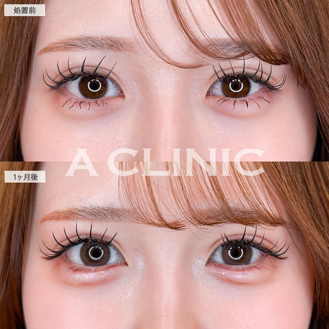 パーフェクトアイズで念願の丸目になれました！こちら処置前と1ヶ月後の症例です(20代女性)