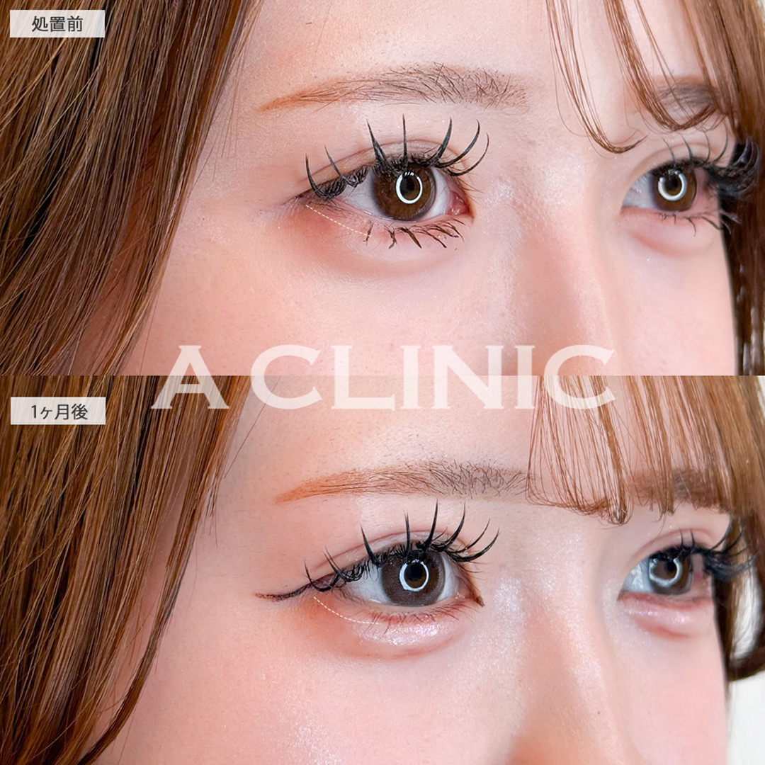 パーフェクトアイズで念願の丸目になれました！こちら処置前と1ヶ月後の症例です(20代女性)