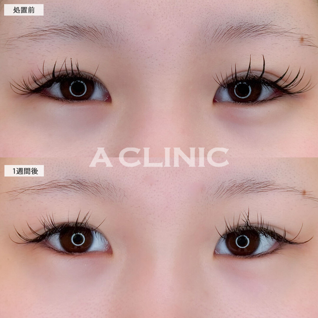 パーフェクトアイズで目尻が下がり可愛らしい目元になります！こちら処置前と1週間後の症例です(20代女性)