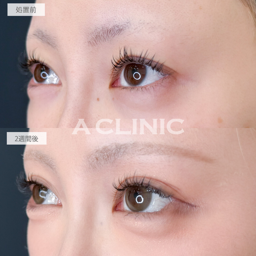 二重術埋没法とパーフェクトアイズでさりげなく目元の印象を変えることができました！処置前と2週間後の症例です(30代女性)