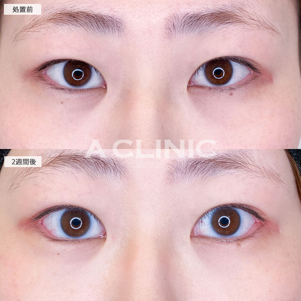 パーフェクトアイズでつり目から丸く大きい目に！こちら処置前と2週間後の症例です(20代女性)