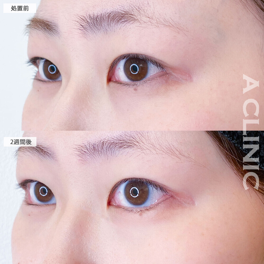 パーフェクトアイズでつり目から丸く大きい目に！こちら処置前と2週間後の症例です(20代女性)