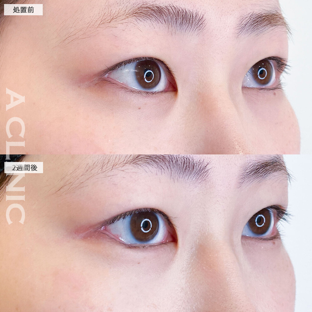 パーフェクトアイズでつり目から丸く大きい目に！こちら処置前と2週間後の症例です(20代女性)