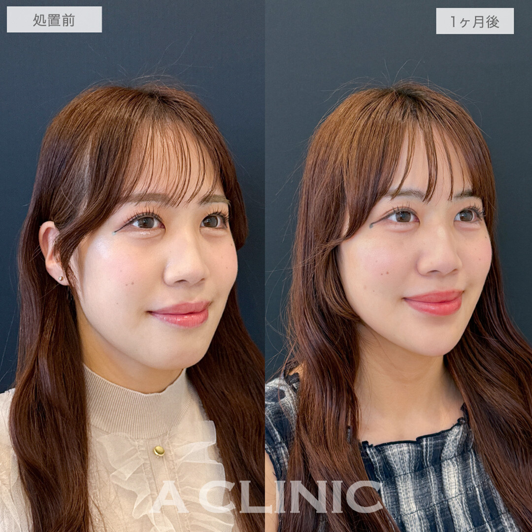 1day小顔脂肪吸引と小顔エラボトックスとあごへのヒアルロン酸注入とボトックス注射(しわ)で加工いらずの憧れていた輪郭へ！処置前と1ヶ月後の症例です(20代女性)