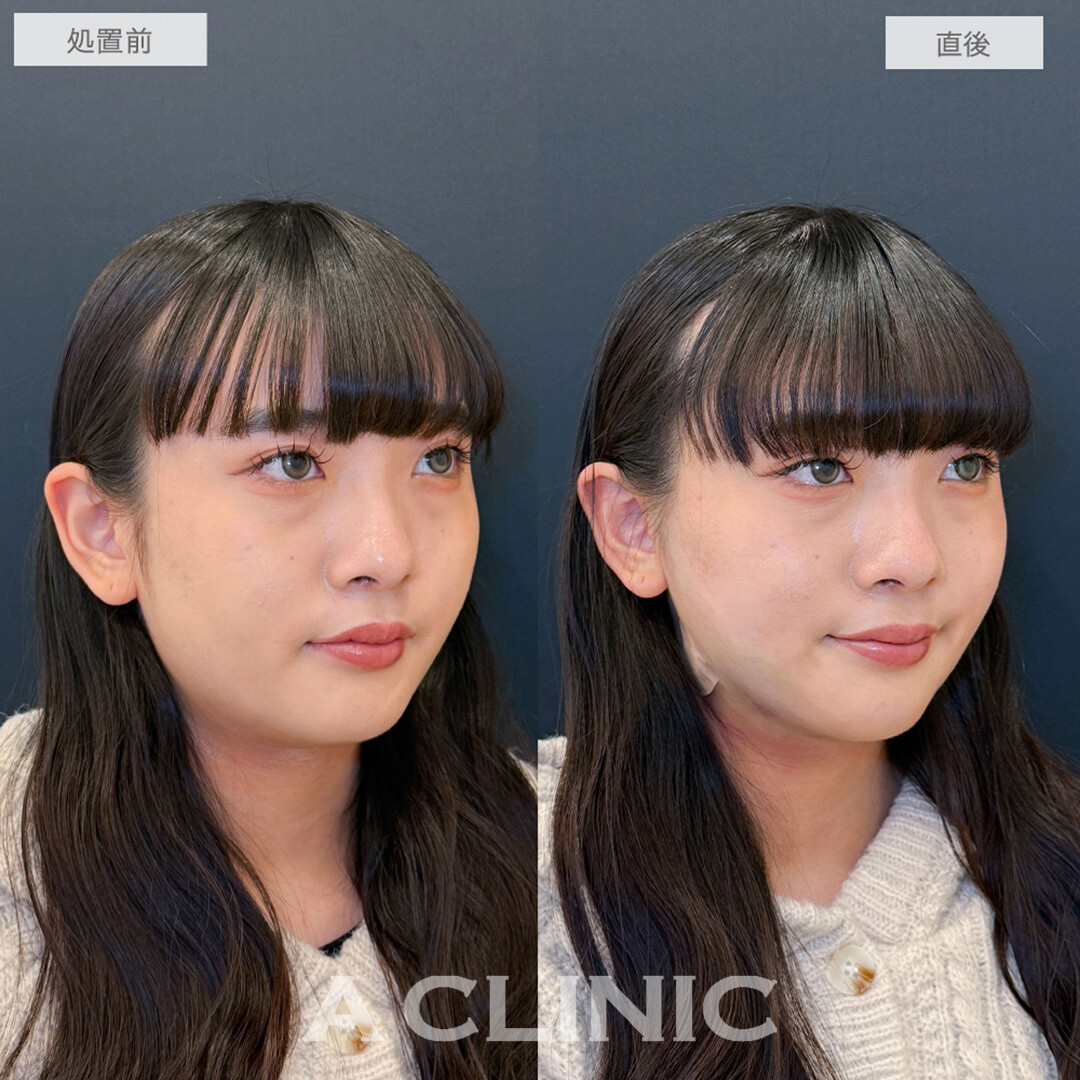 1day小顔脂肪吸引で直後から別人級のフェイスラインが誕生しました！処置前と直後の症例です(20代女性)