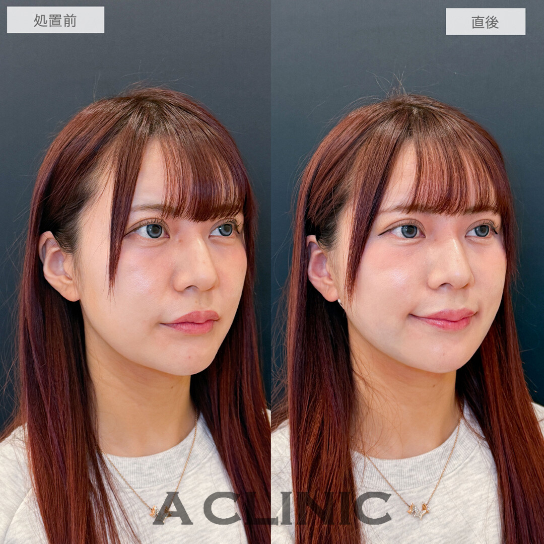 1day小顔脂肪吸引で直後からフェイスラインのもたつきが解消されました！処置前と直後の症例です(30代女性)