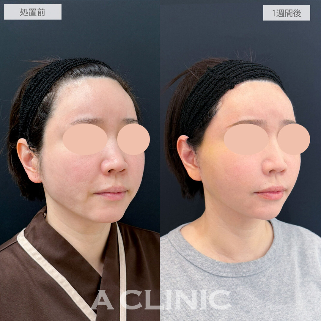 【直後の傷跡あり】A式美肌たるみ切開と小顔エラボトックスとヒアルロン酸注射(シワ)でほうれい線がなくなり若返り成功！処置前と1週間後の症例です(40代女性)