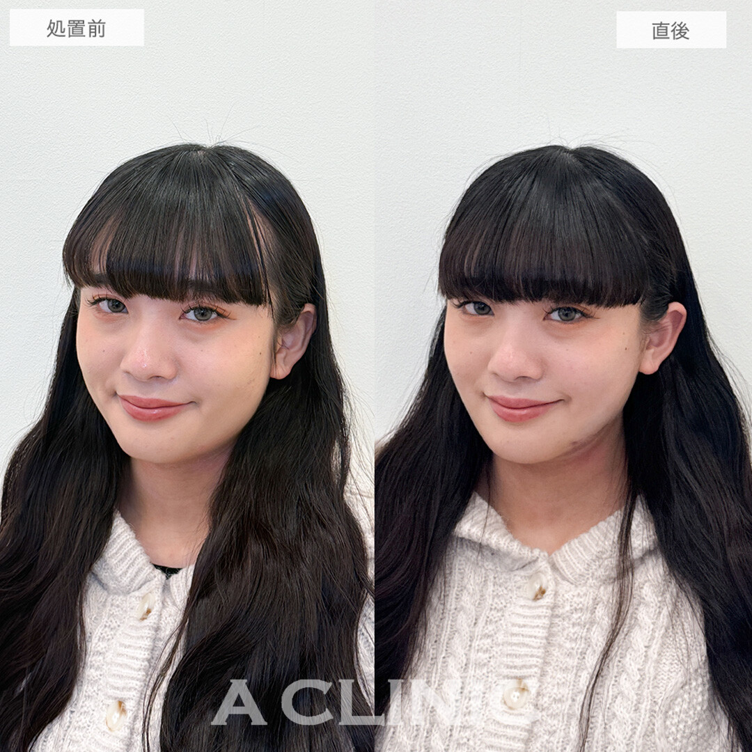 1day小顔脂肪吸引で直後から別人級のフェイスラインが誕生しました！処置前と直後の症例です(20代女性)