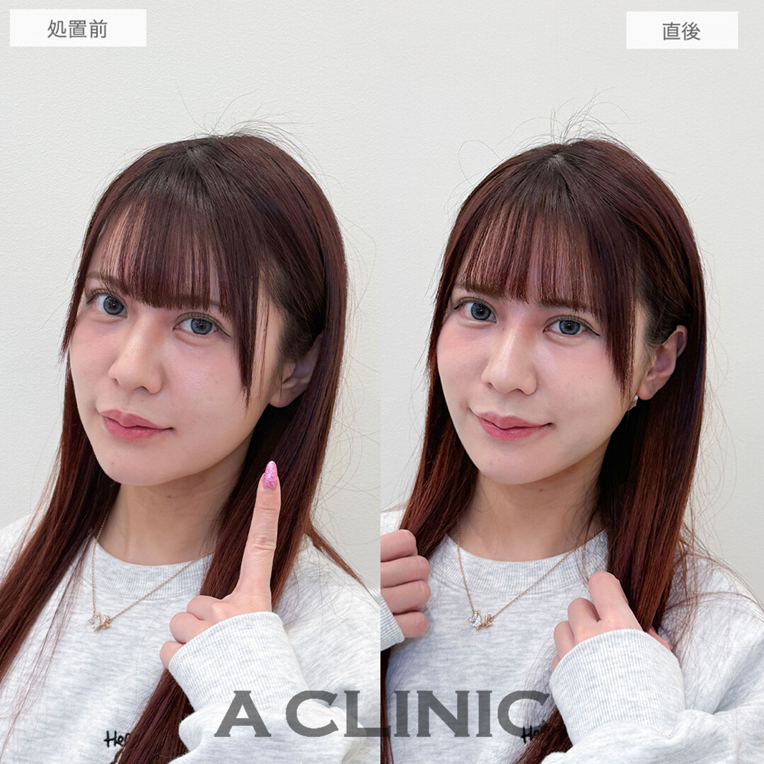 1day小顔脂肪吸引で直後からフェイスラインのもたつきが解消されました！処置前と直後の症例です(30代女性)