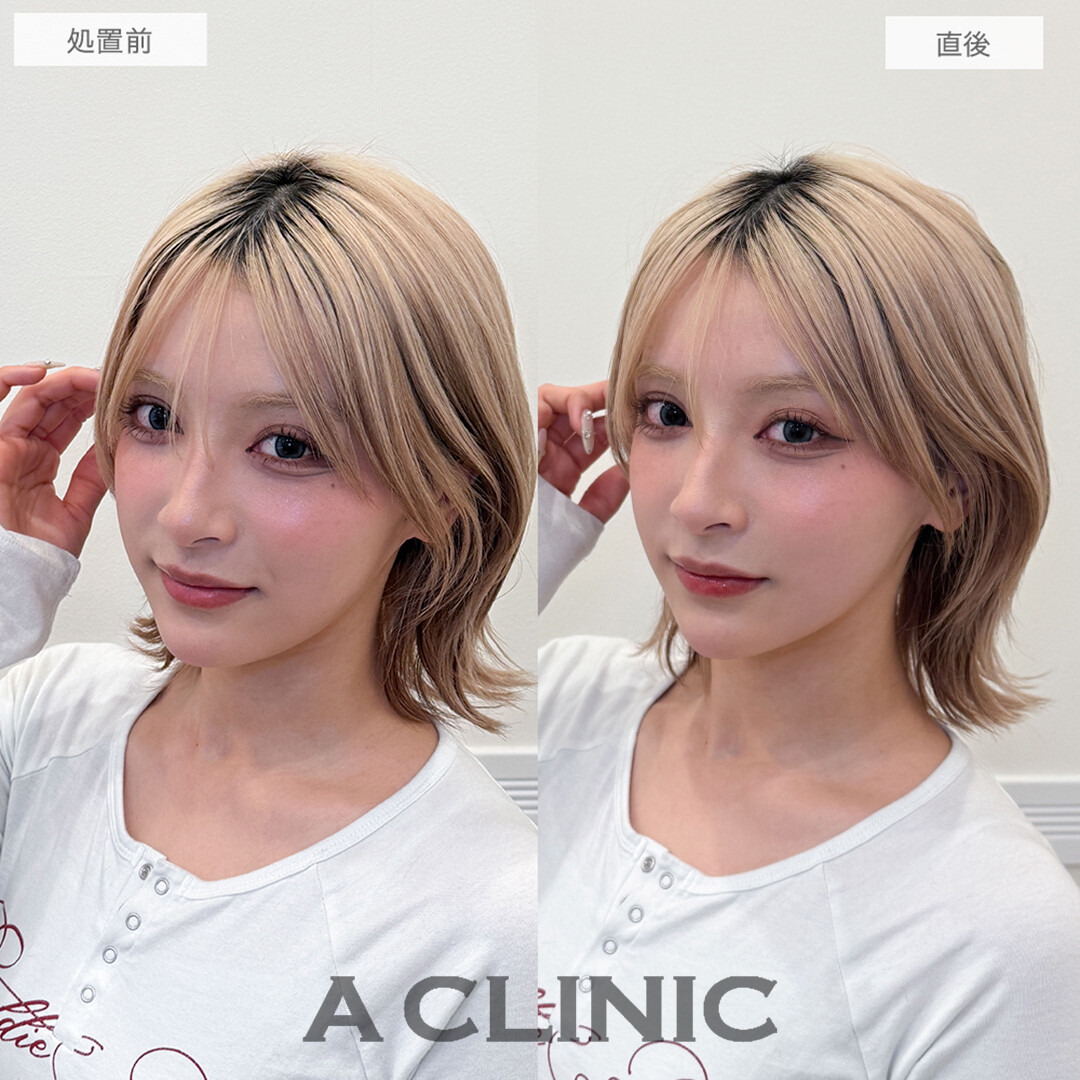 Aスレッドで輪郭が整い可愛さアップデート！処置前と直後の症例です(20代女性)