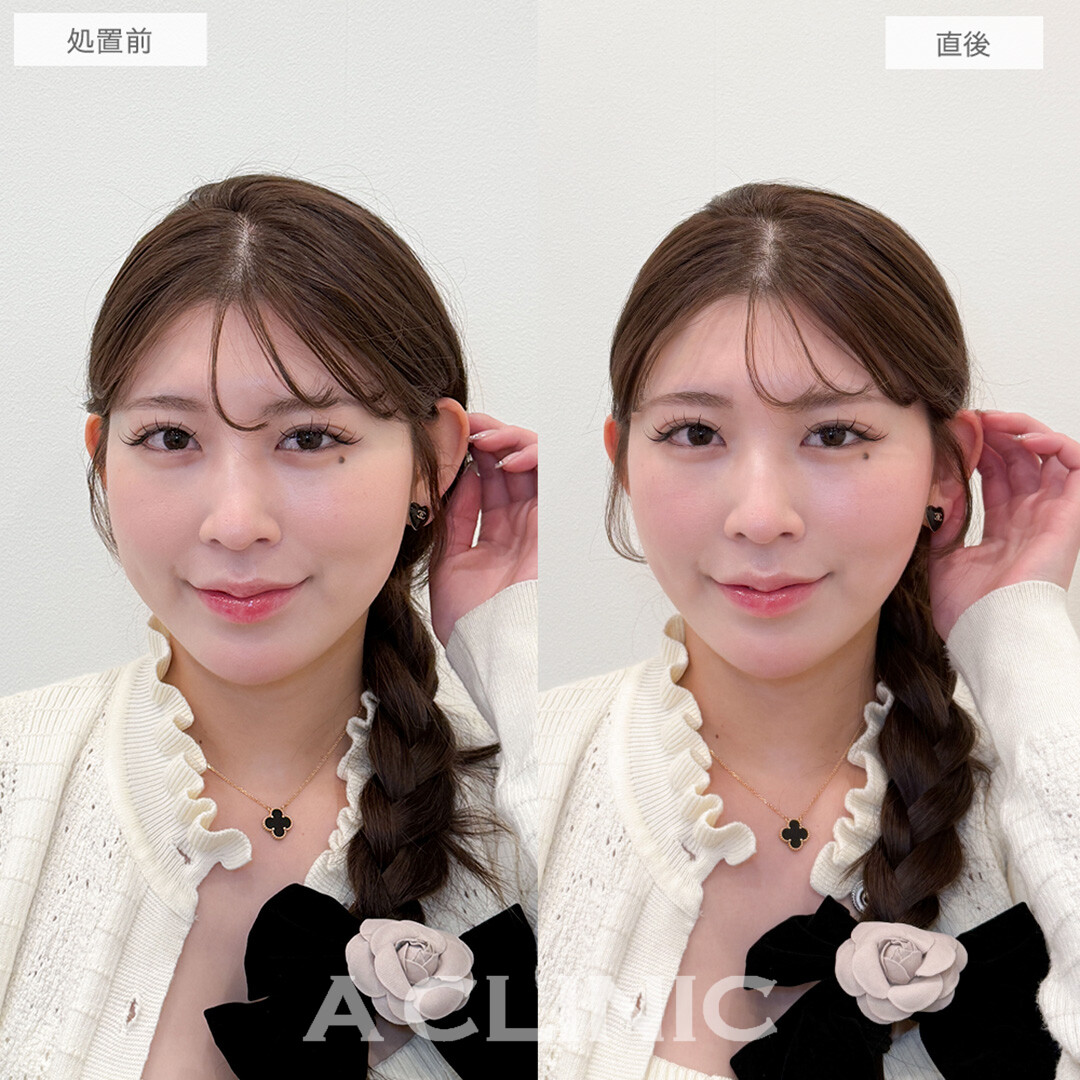 Aスレッドで即日自分に合った小顔が手に入りました！処置前と直後の症例です(20代女性)