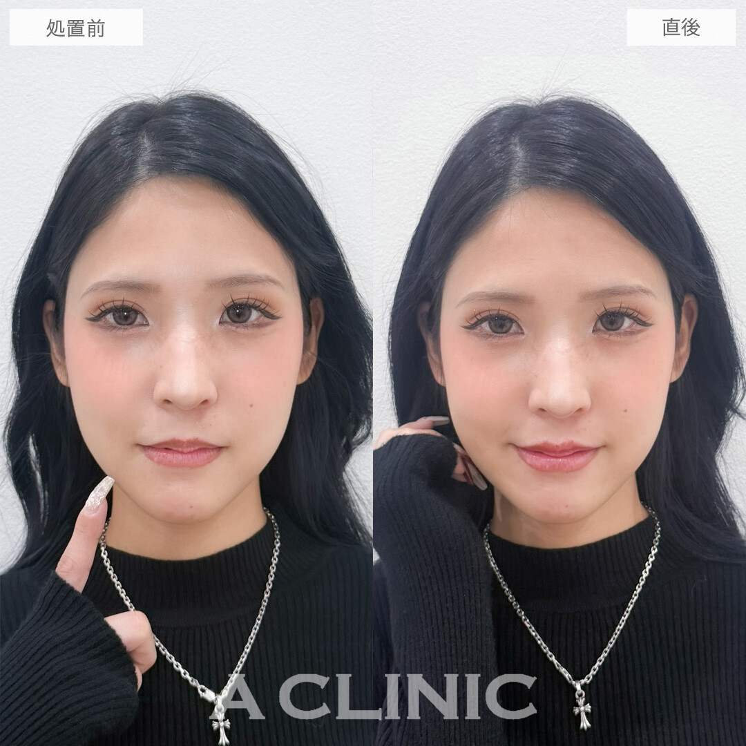 スマイルリップで唇の形が整いました！こちら処置前と直後の症例です(20代女性)