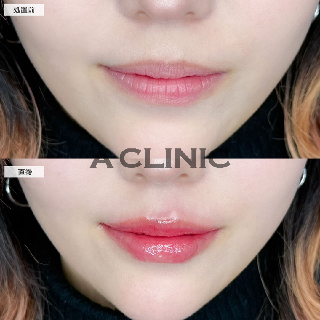 スマイルリップでメイク映えする唇に！こちら処置前と直後の症例です(20代女性)