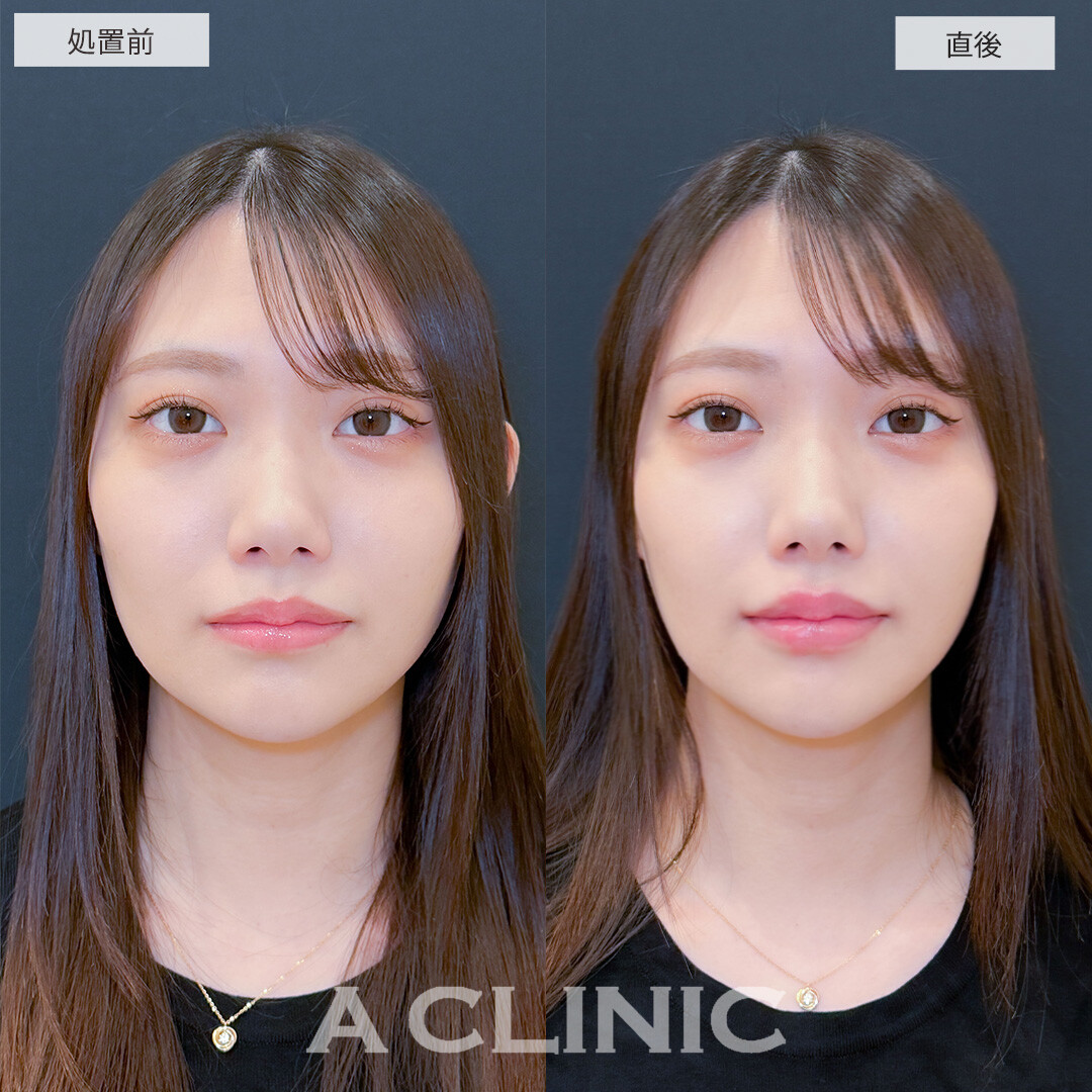 スマイルリップで左右差を整えナチュラルに唇がボリュームアップしました！こちら処置前と直後の症例です(20代女性)