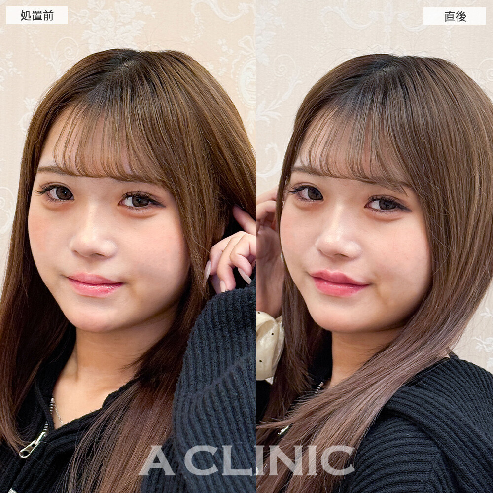 スマイルリップで唇をぷっくりさせることでお顔のパーツもはっきり見えます！こちら処置前と直後の症例です(10代女性)