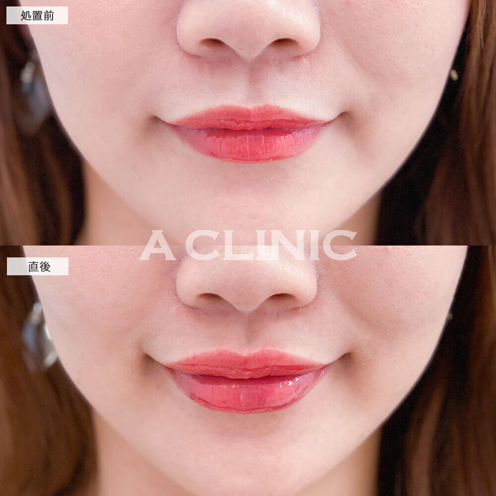 スマイルリップでより存在感のある唇に！こちら処置前と直後の症例です(30代女性)