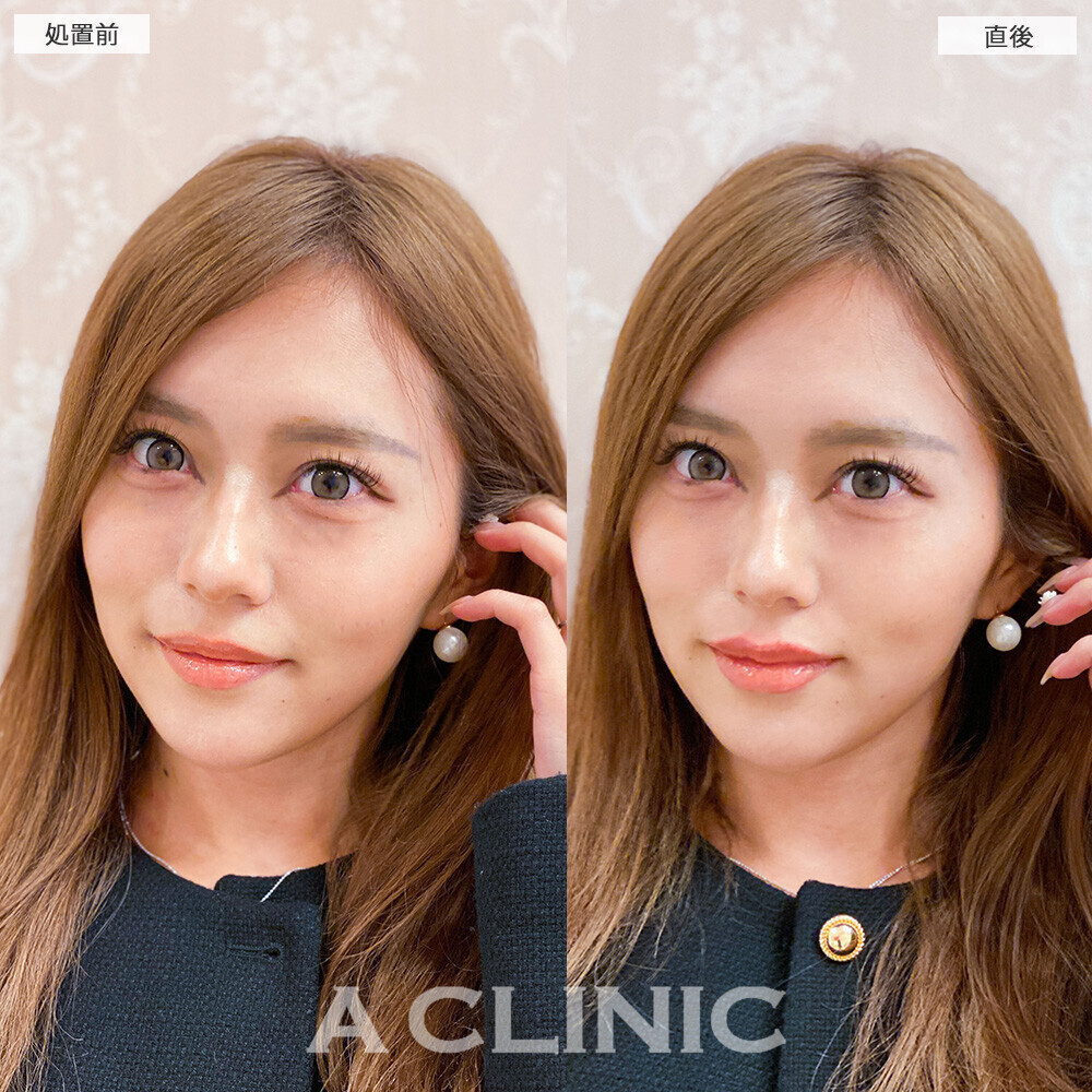 スマイルリップでよりはっきりしたお顔に！こちら処置前と直後の症例です(20代女性)