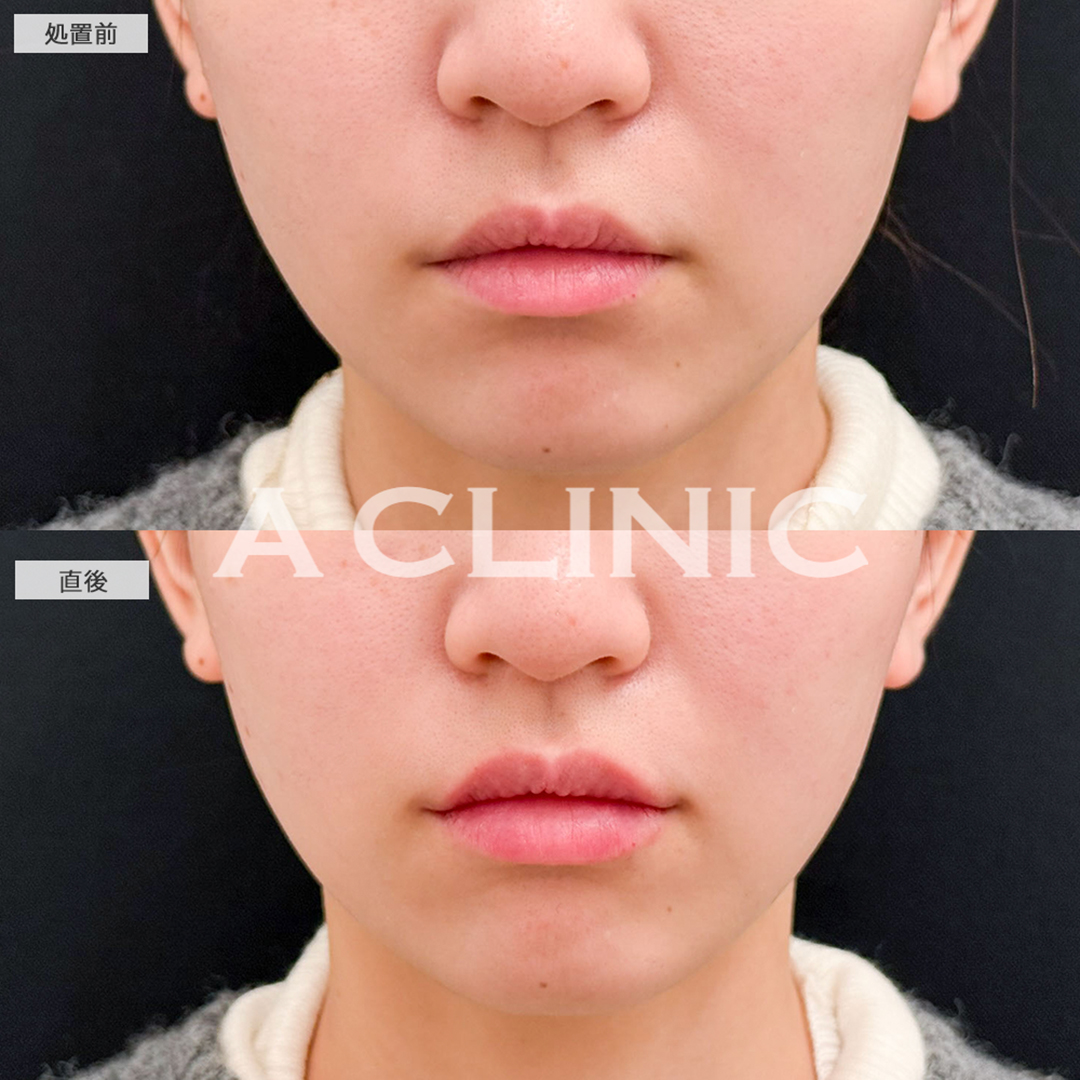 リップヒアルロン酸注入で口角が上がり可愛らしい唇に！こちら処置前と直後の症例です(20代女性)