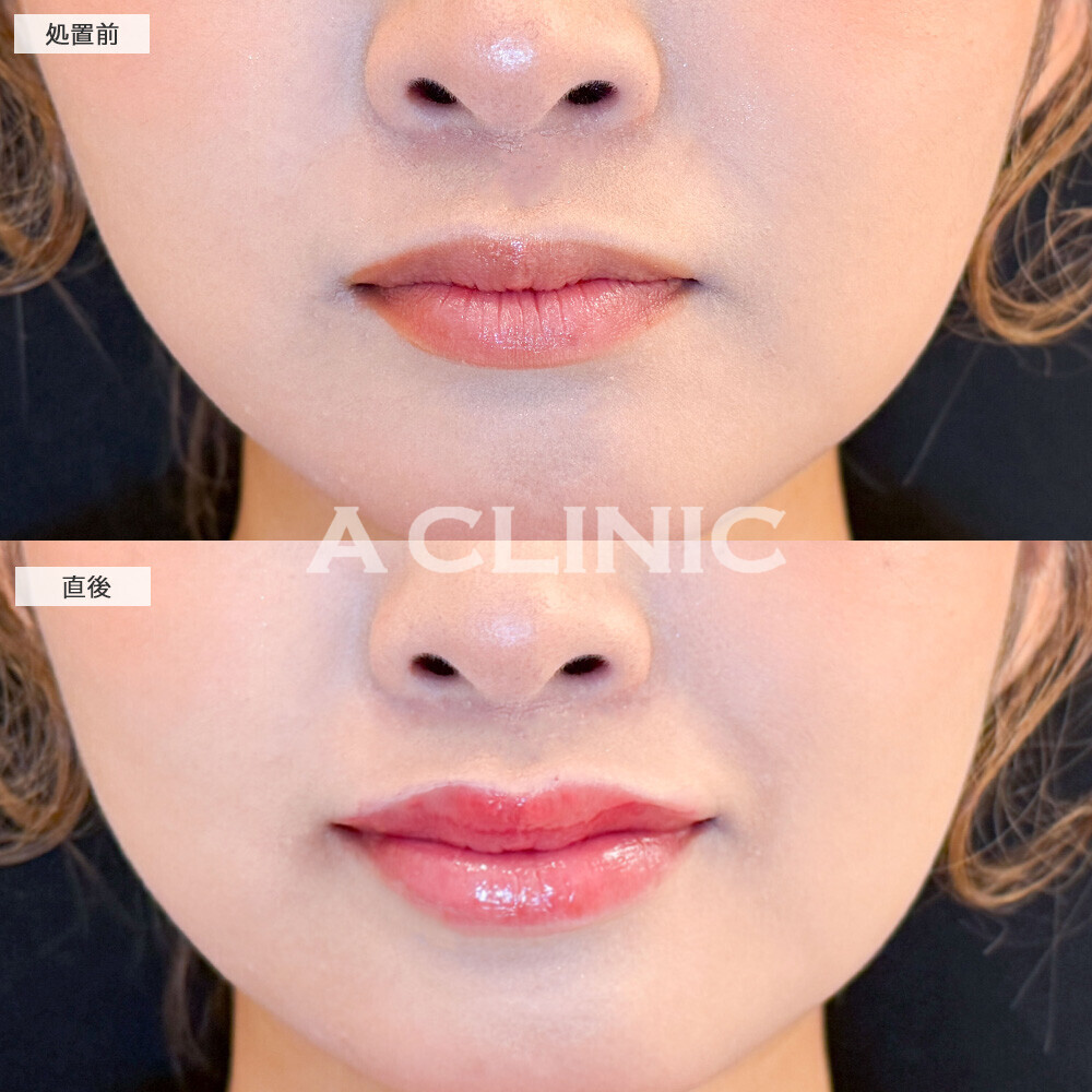 スマイルリップでぷるんと存在感のある唇に！こちら処置前と直後の症例です(20代女性)
