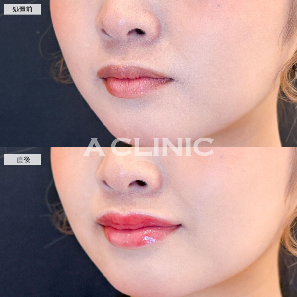 スマイルリップでぷるんと存在感のある唇に！こちら処置前と直後の症例です(20代女性)
