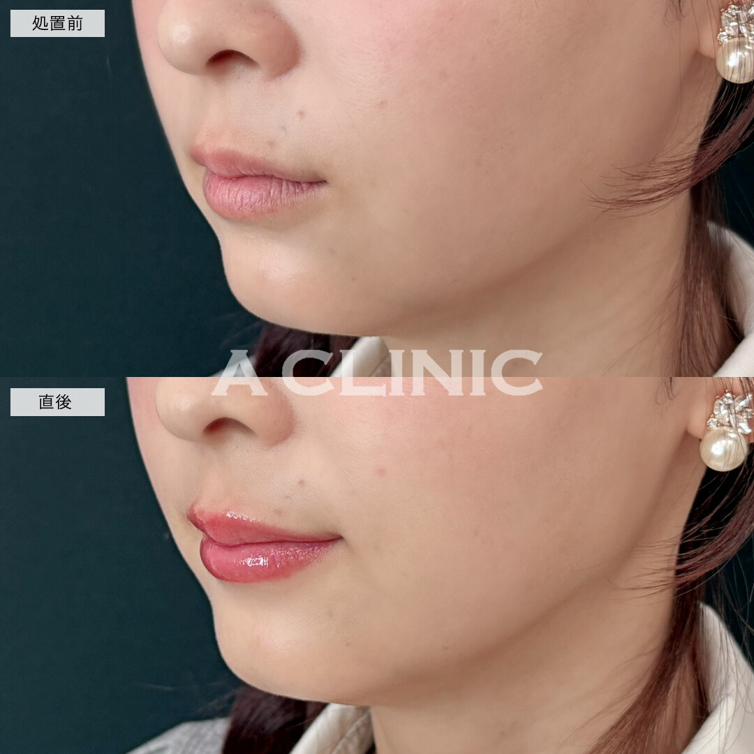 スマイルリップでボリュームのあるぷっくり唇に！処置前と直後の症例です(30代女性)