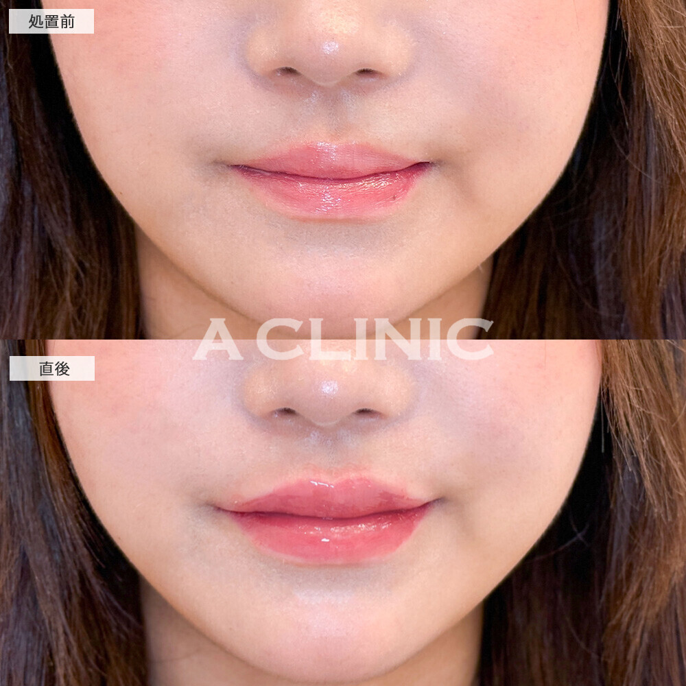 スマイルリップで唇をぷっくりさせることでお顔のパーツもはっきり見えます！こちら処置前と直後の症例です(10代女性)