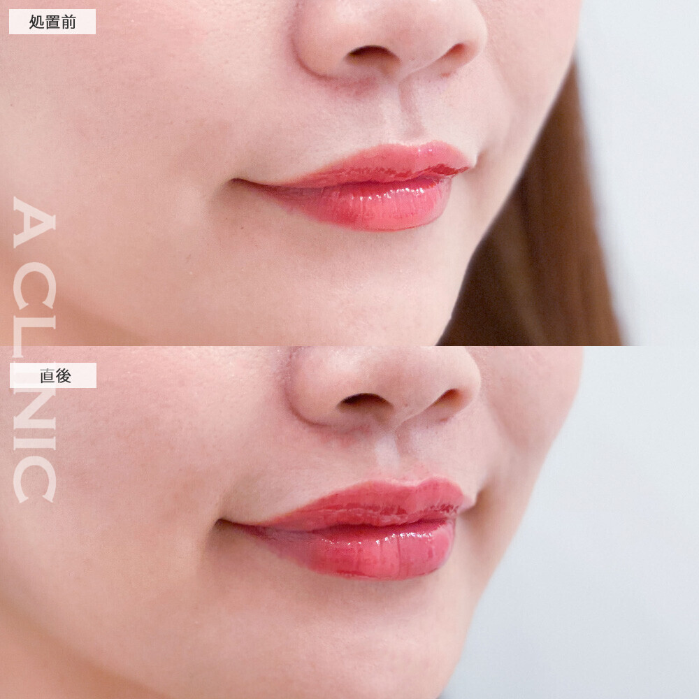 スマイルリップでより存在感のある唇に！こちら処置前と直後の症例です(30代女性)