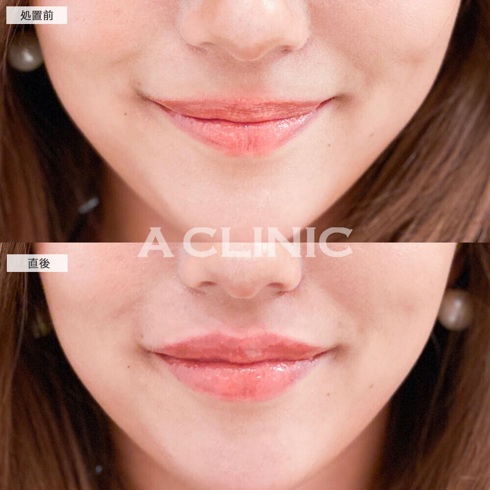 スマイルリップでよりはっきりしたお顔に！こちら処置前と直後の症例です(20代女性)