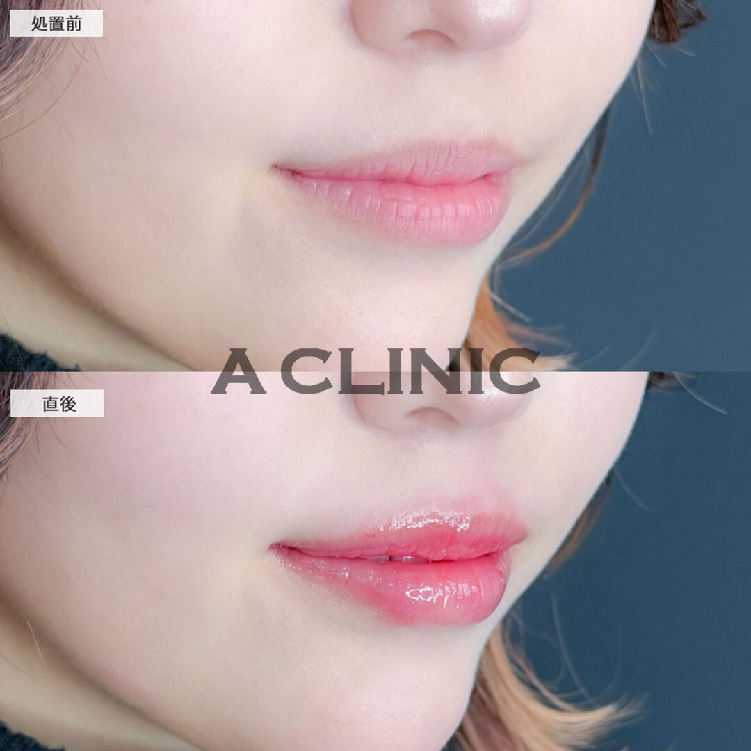 スマイルリップでメイク映えする唇に！こちら処置前と直後の症例です(20代女性)