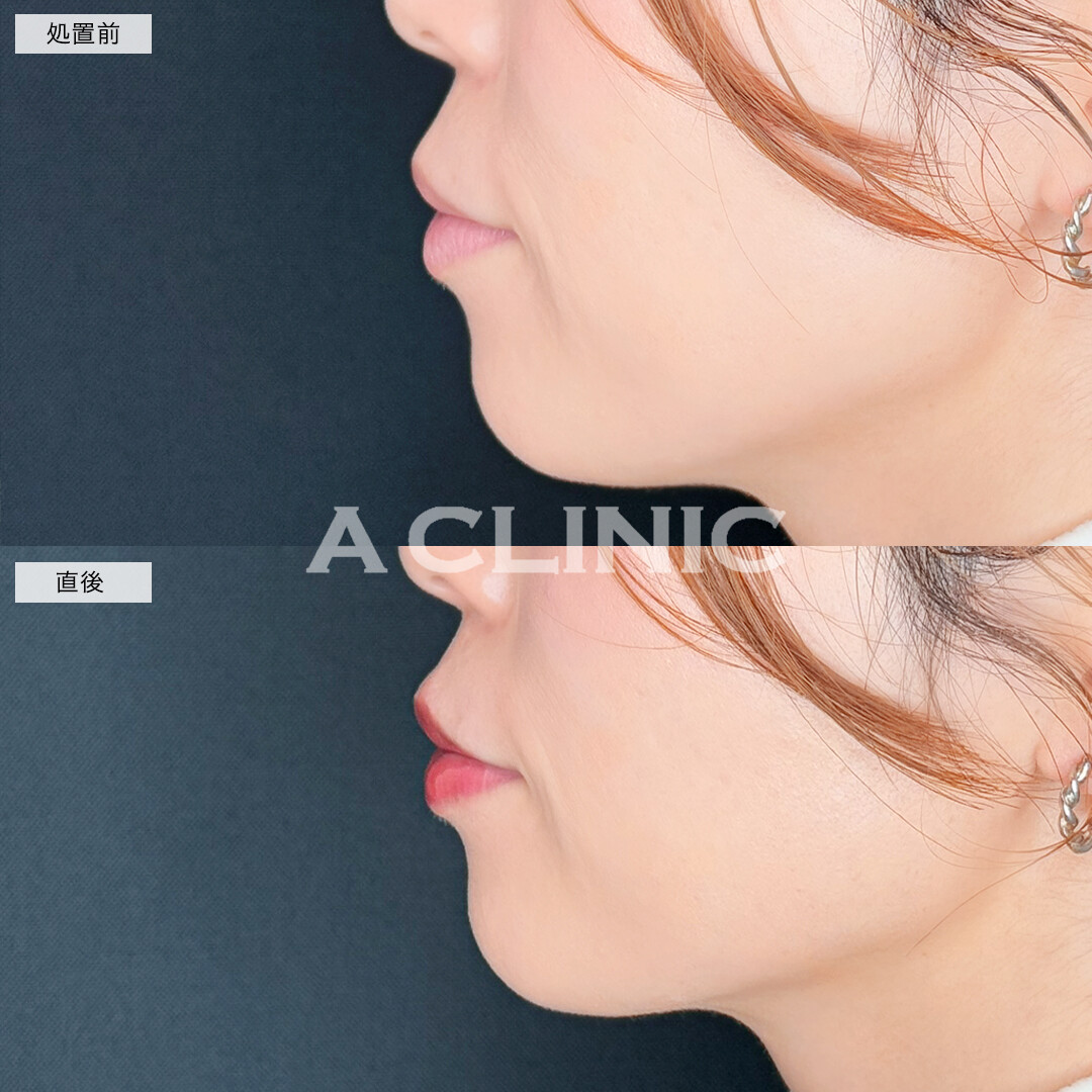 スマイルリップで厚みのある魅力的な唇に！処置前と直後の症例です(30代女性)