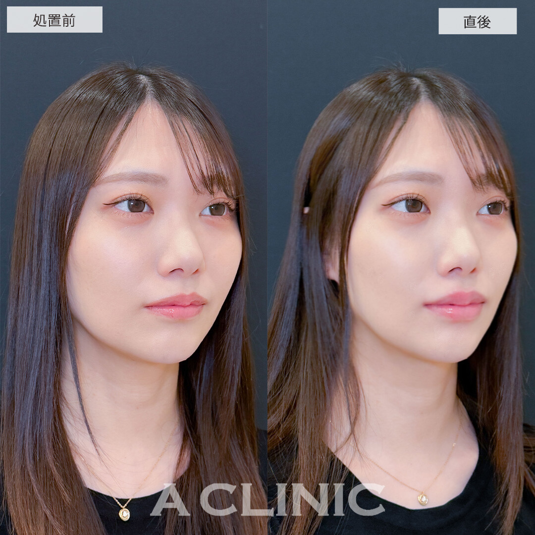 スマイルリップで左右差を整えナチュラルに唇がボリュームアップしました！こちら処置前と直後の症例です(20代女性)