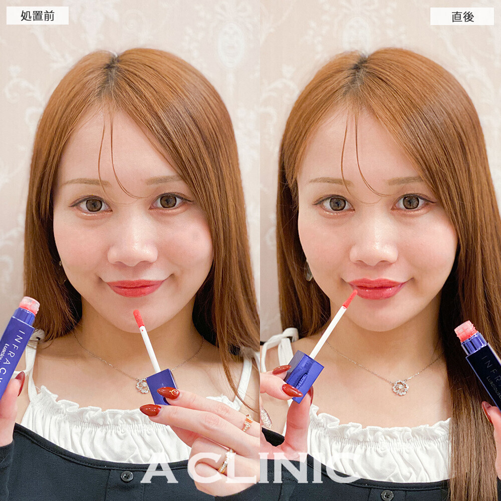 スマイルリップでより存在感のある唇に！こちら処置前と直後の症例です(30代女性)