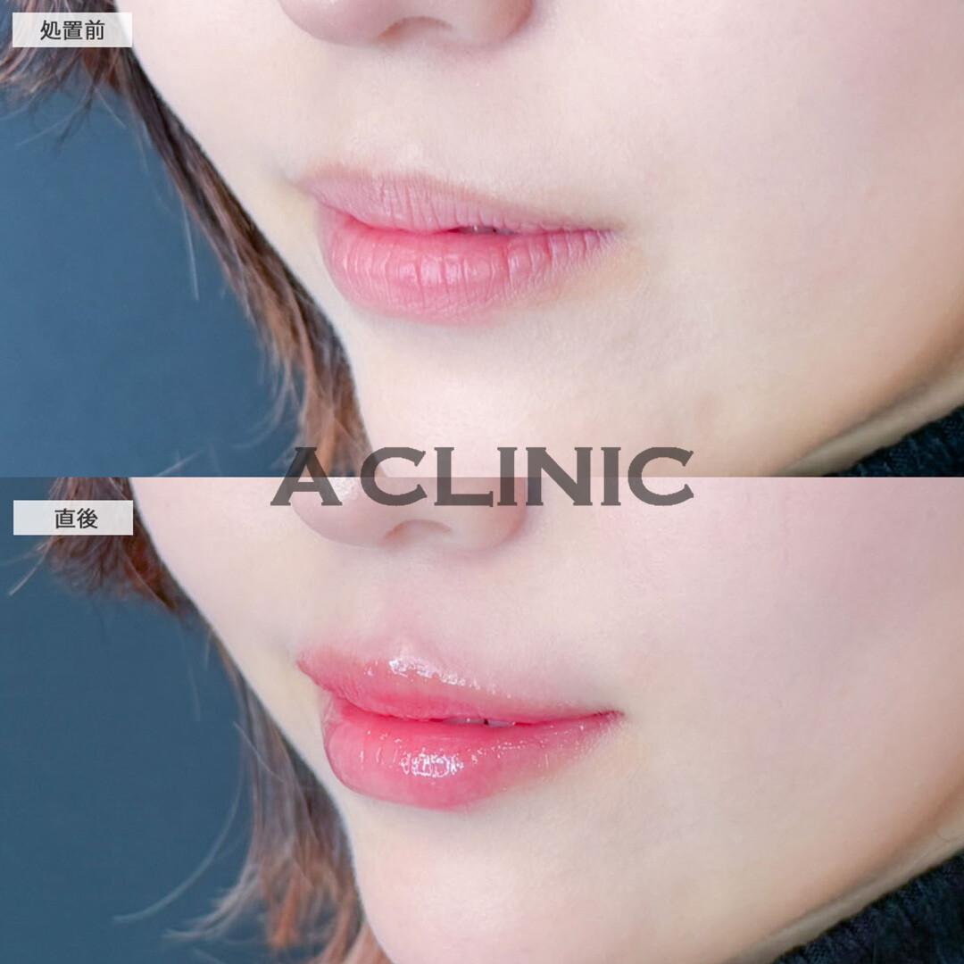 スマイルリップでメイク映えする唇に！こちら処置前と直後の症例です(20代女性)
