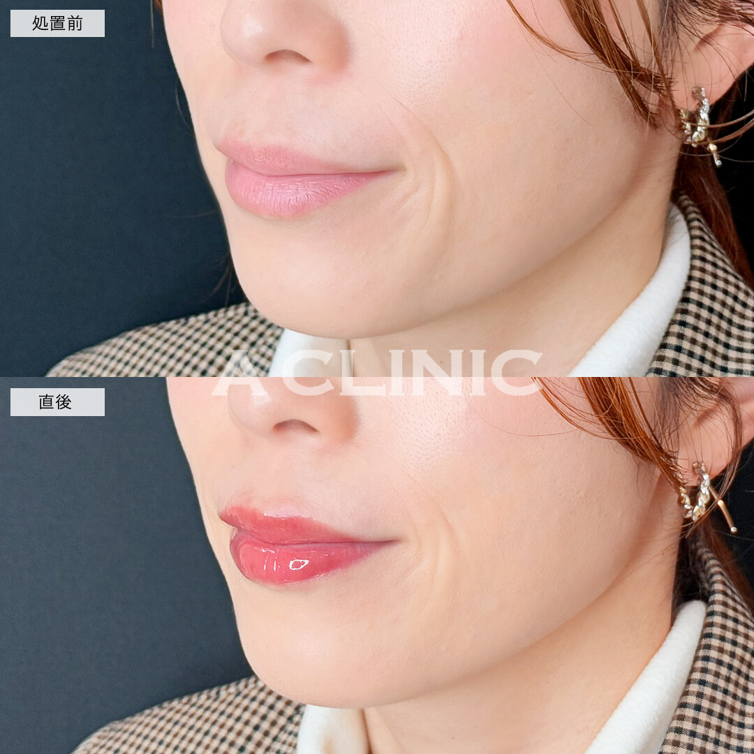 スマイルリップで厚みのある魅力的な唇に！処置前と直後の症例です(30代女性)
