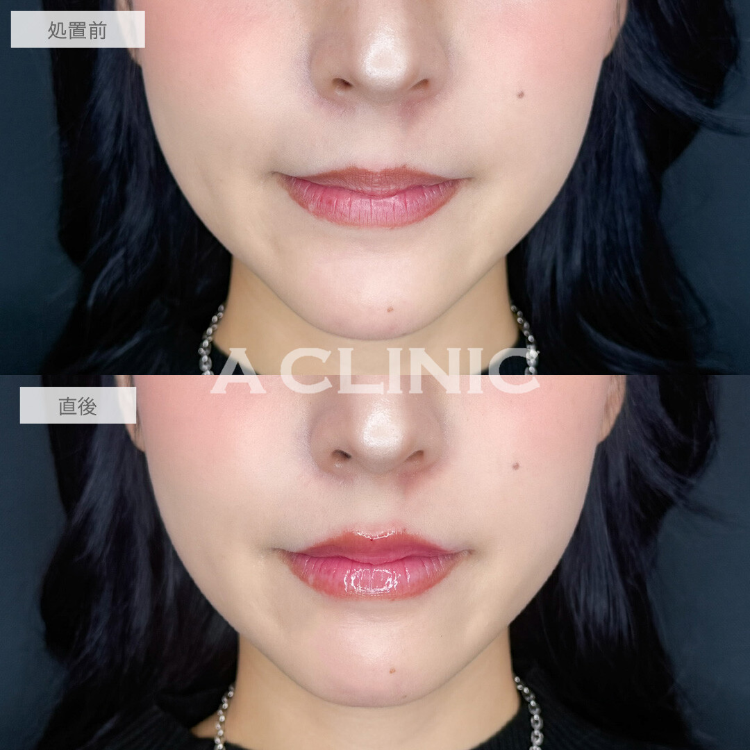 スマイルリップで唇の形が整いました！こちら処置前と直後の症例です(20代女性)