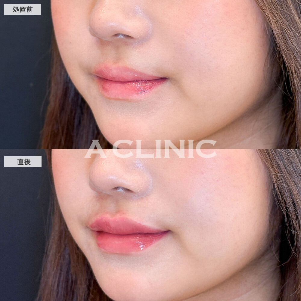 スマイルリップで唇をぷっくりさせることでお顔のパーツもはっきり見えます！こちら処置前と直後の症例です(10代女性)
