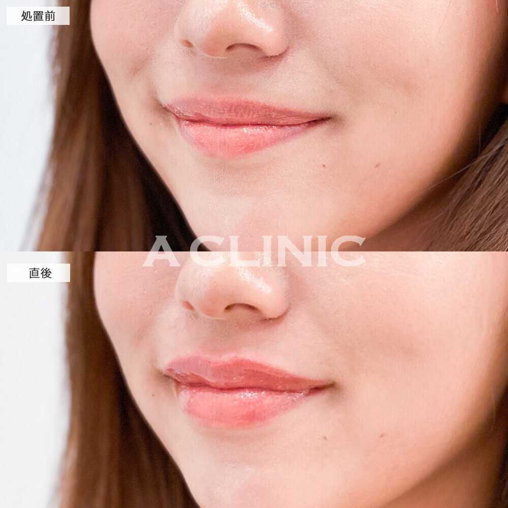 スマイルリップでよりはっきりしたお顔に！こちら処置前と直後の症例です(20代女性)