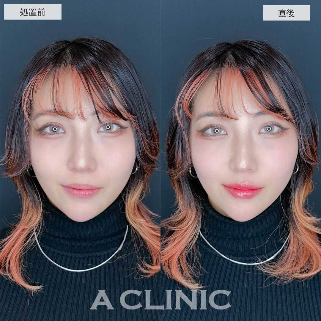 スマイルリップでメイク映えする唇に！こちら処置前と直後の症例です(20代女性)