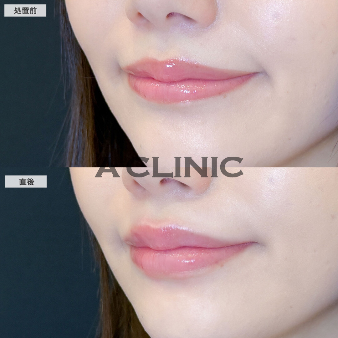 スマイルリップで左右差を整えナチュラルに唇がボリュームアップしました！こちら処置前と直後の症例です(20代女性)