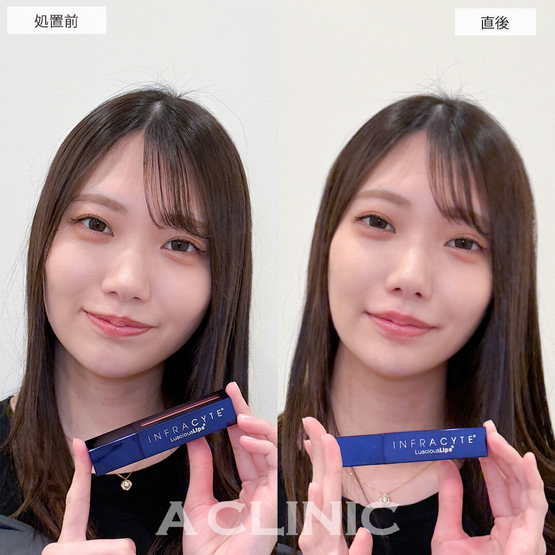 スマイルリップで左右差を整えナチュラルに唇がボリュームアップしました！こちら処置前と直後の症例です(20代女性)