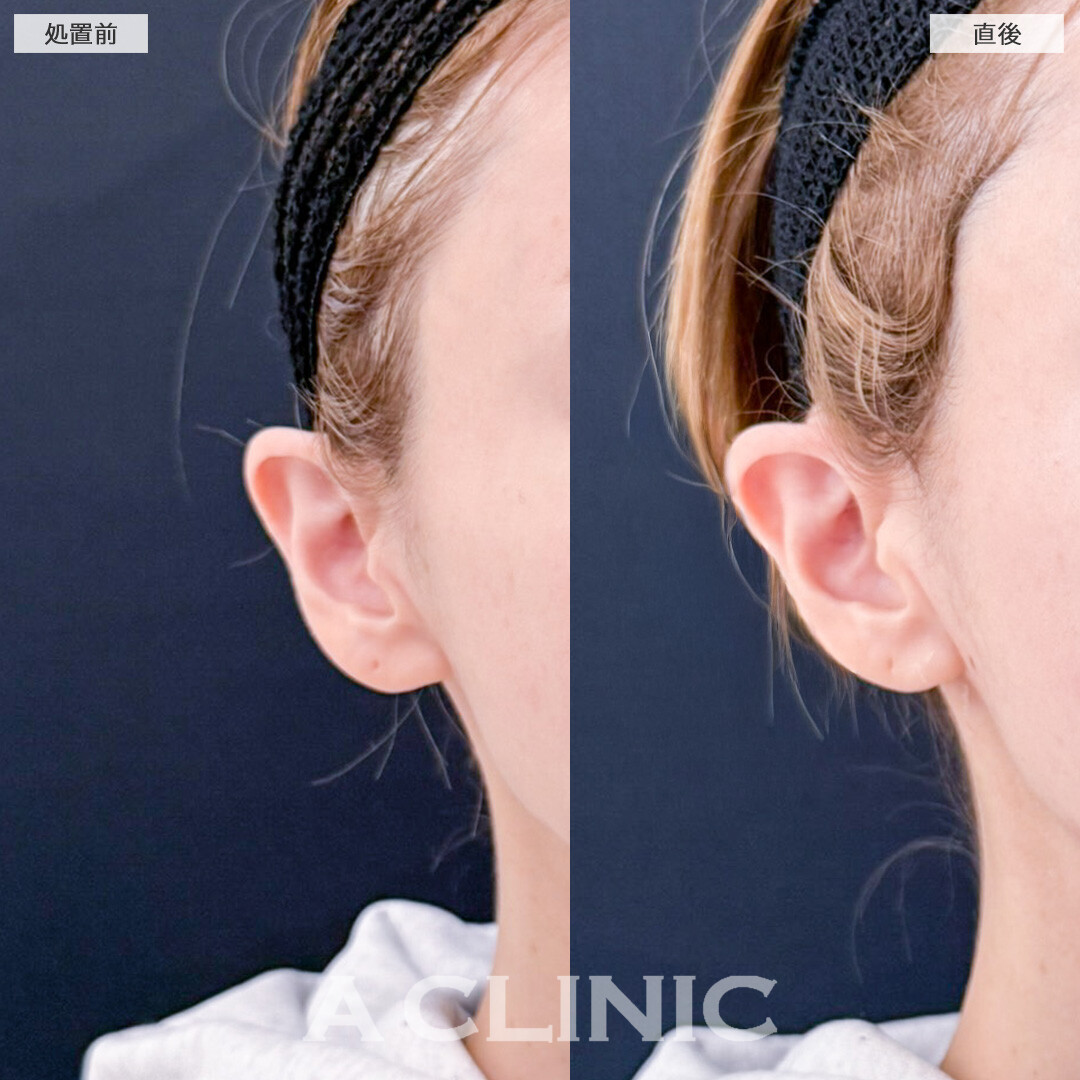 立ち耳ヒアルロン酸注入(ボリューマ)したら童顔になってお顔の印象が柔らかくなりました！こちら処置前と直後の症例です(30代女性)