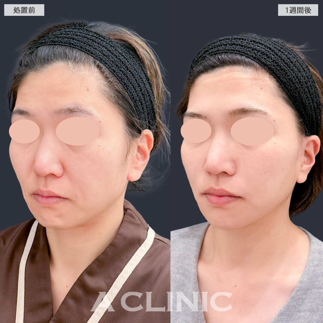 A式ナゾラリフトとグロースファクター注射でお疲れ顔から大変身できました！こちら処置前と1週間後の症例です(30代女性)