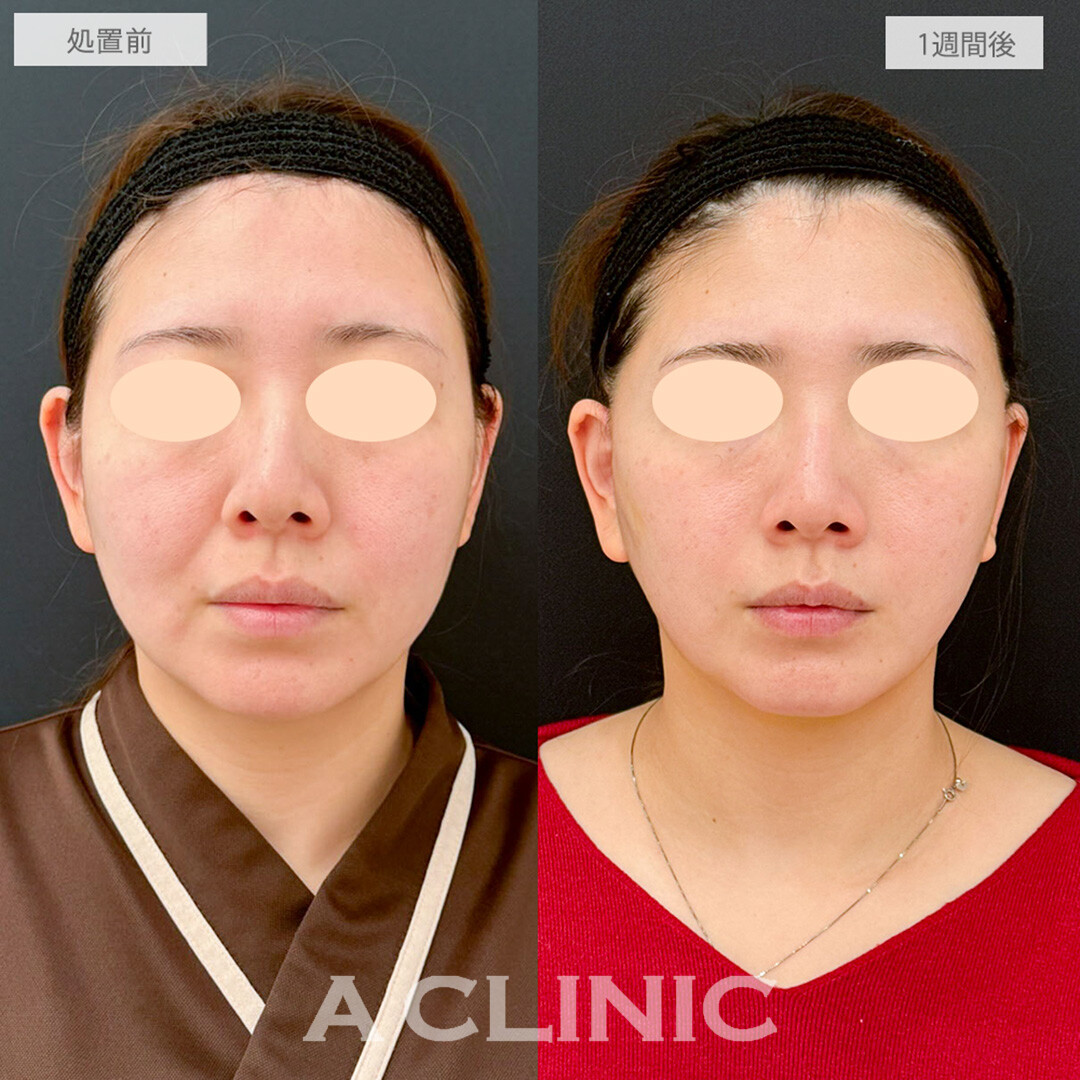 【直後の傷跡あり】A式美肌たるみ切開と1day小顔脂肪吸引で別人級の卵型フェイスに！処置前と1週間後の症例です(30代女性)