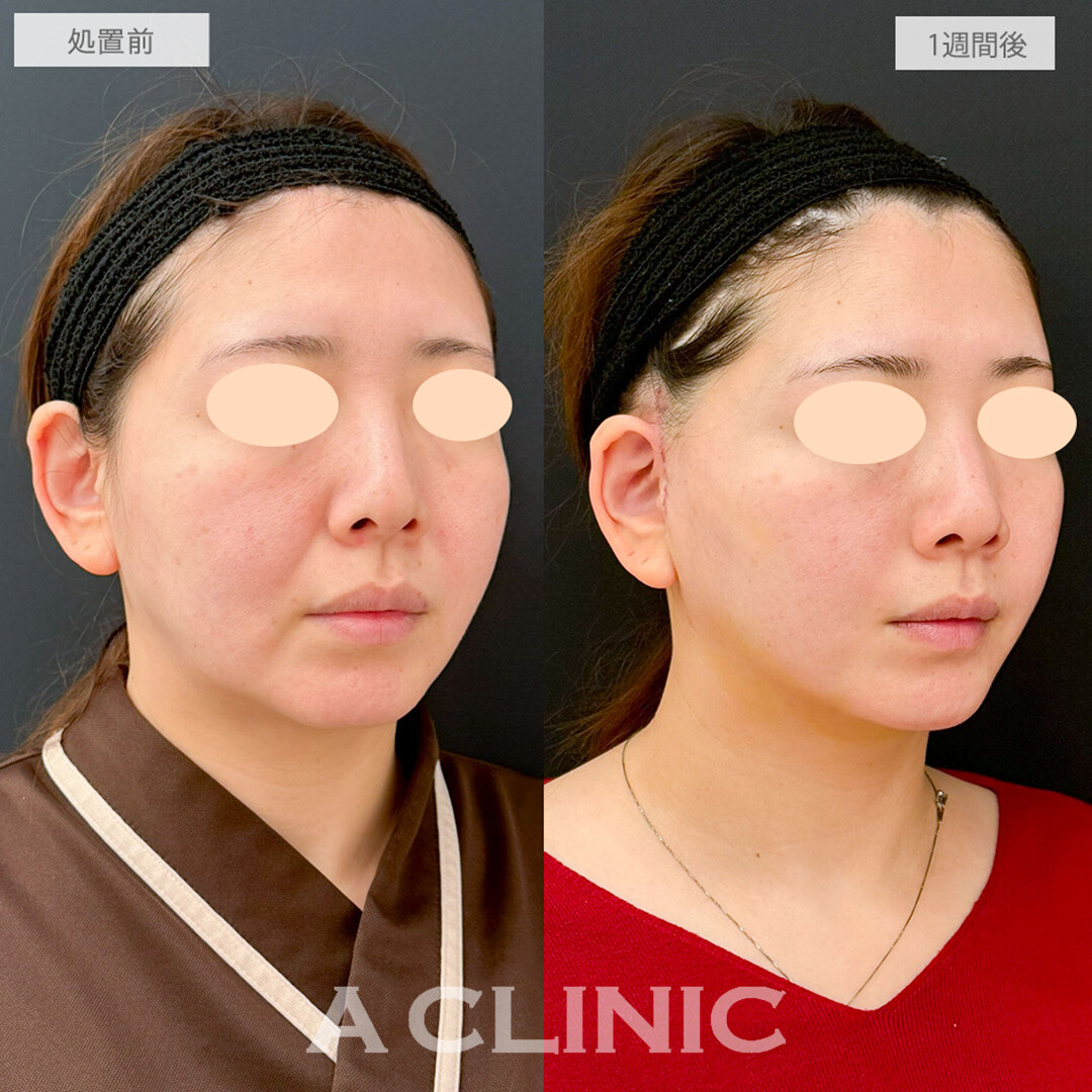 【直後の傷跡あり】A式美肌たるみ切開と1day小顔脂肪吸引で別人級の卵型フェイスに！処置前と1週間後の症例です(30代女性)