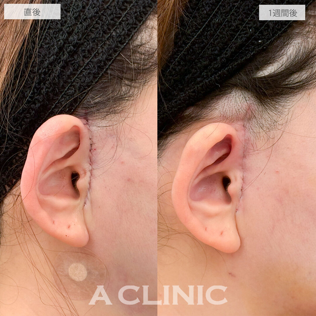 【直後の傷跡あり】A式美肌たるみ切開と1day小顔脂肪吸引で別人級の卵型フェイスに！処置前と1週間後の症例です(30代女性)