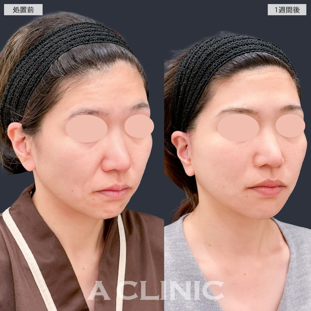 A式ナゾラリフトとグロースファクター注射でお疲れ顔から大変身できました！こちら処置前と1週間後の症例です(30代女性)