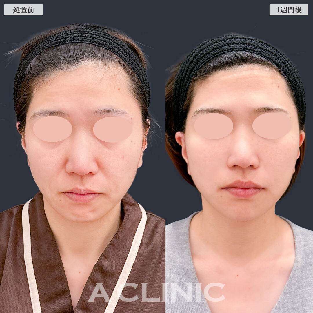 A式ナゾラリフトとグロースファクター注射でお疲れ顔から大変身できました！こちら処置前と1週間後の症例です(30代女性)