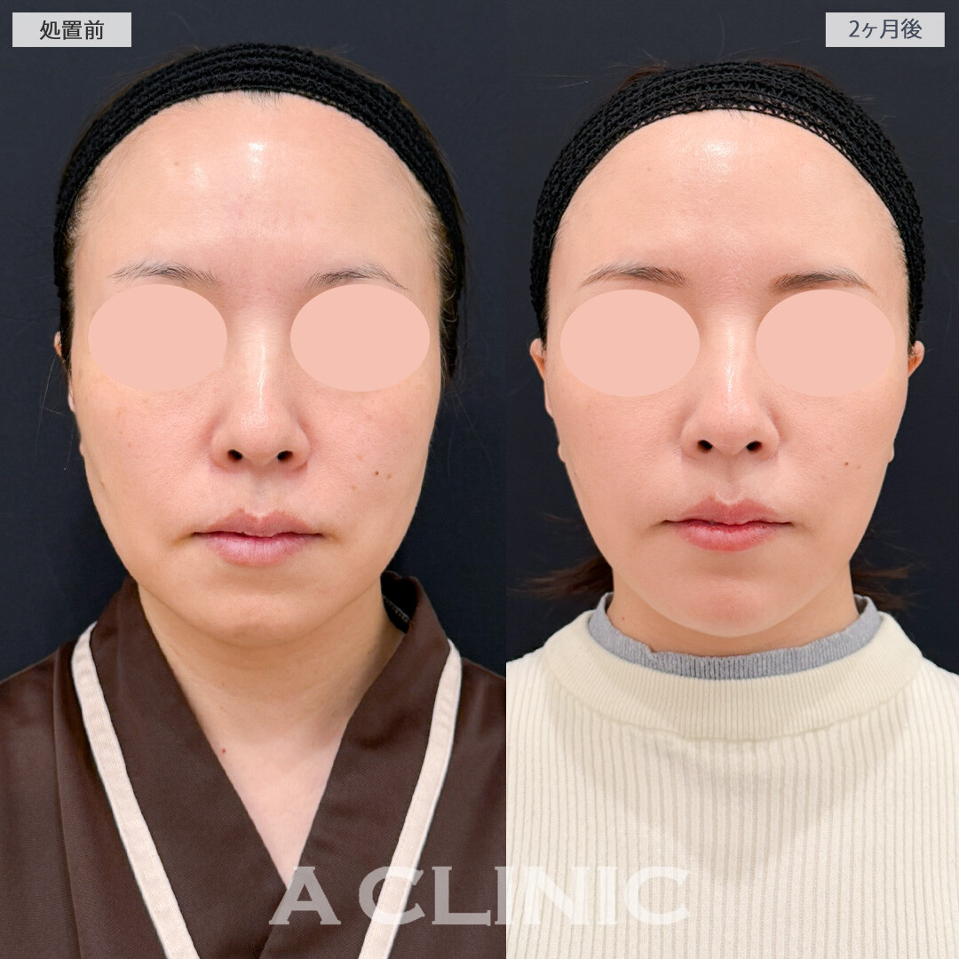 1day小顔脂肪吸引とA式美肌たるみ切開でたるみも脂肪もスッキリ解消！処置前と2ヶ月後の症例です(40代女性)