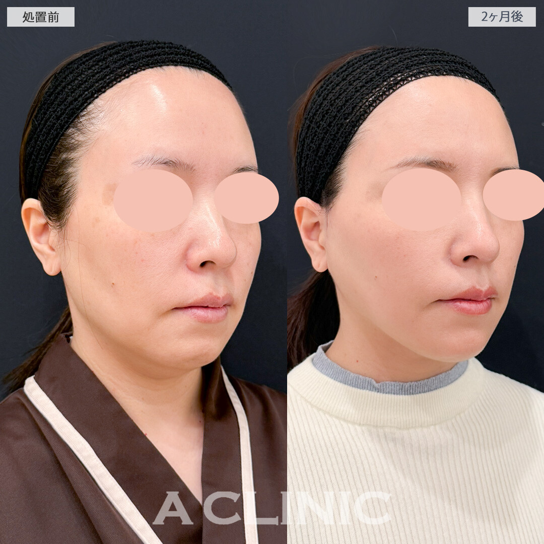 1day小顔脂肪吸引とA式美肌たるみ切開でたるみも脂肪もスッキリ解消！処置前と2ヶ月後の症例です(40代女性)