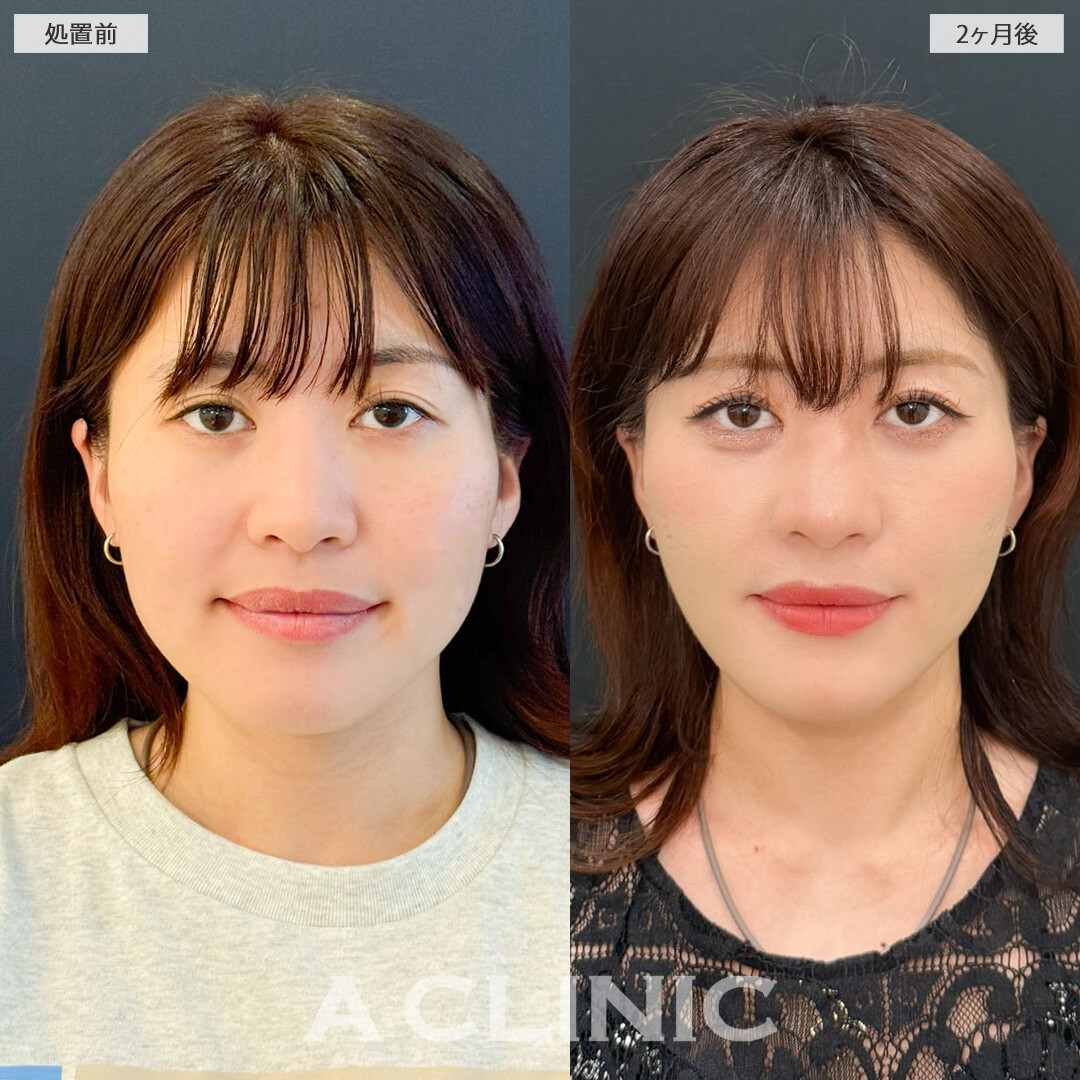 A式美肌たるみ切開と1day小顔脂肪吸引で余白が無くなりスッキリ小顔に！こちら処置前と2ヶ月後の症例です(20代女性）